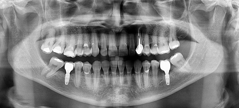 Foto 2 de Walter Almeida Implantes Belém