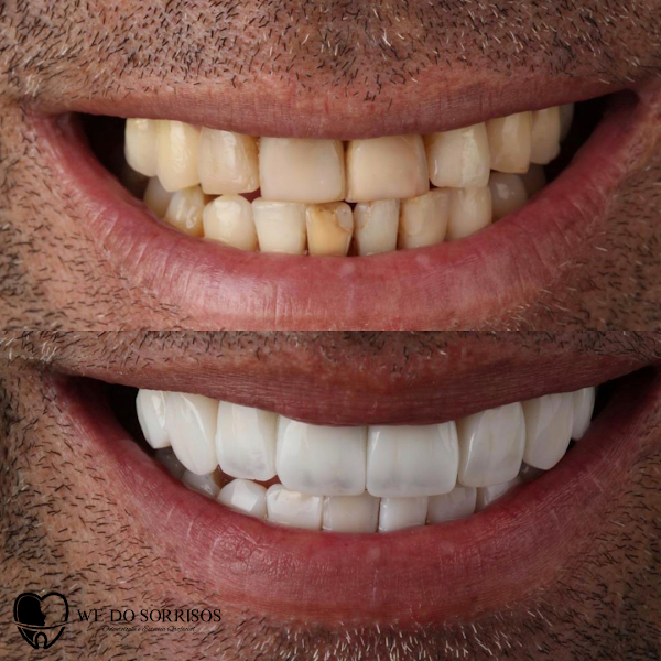 Foto 2 de We Do Sorrisos - DENTISTA EM NITERÓI - FACETAS EM RESINA